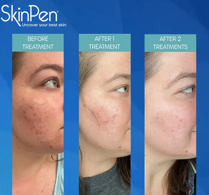 SkinPen Microneedling Warendorf Münster